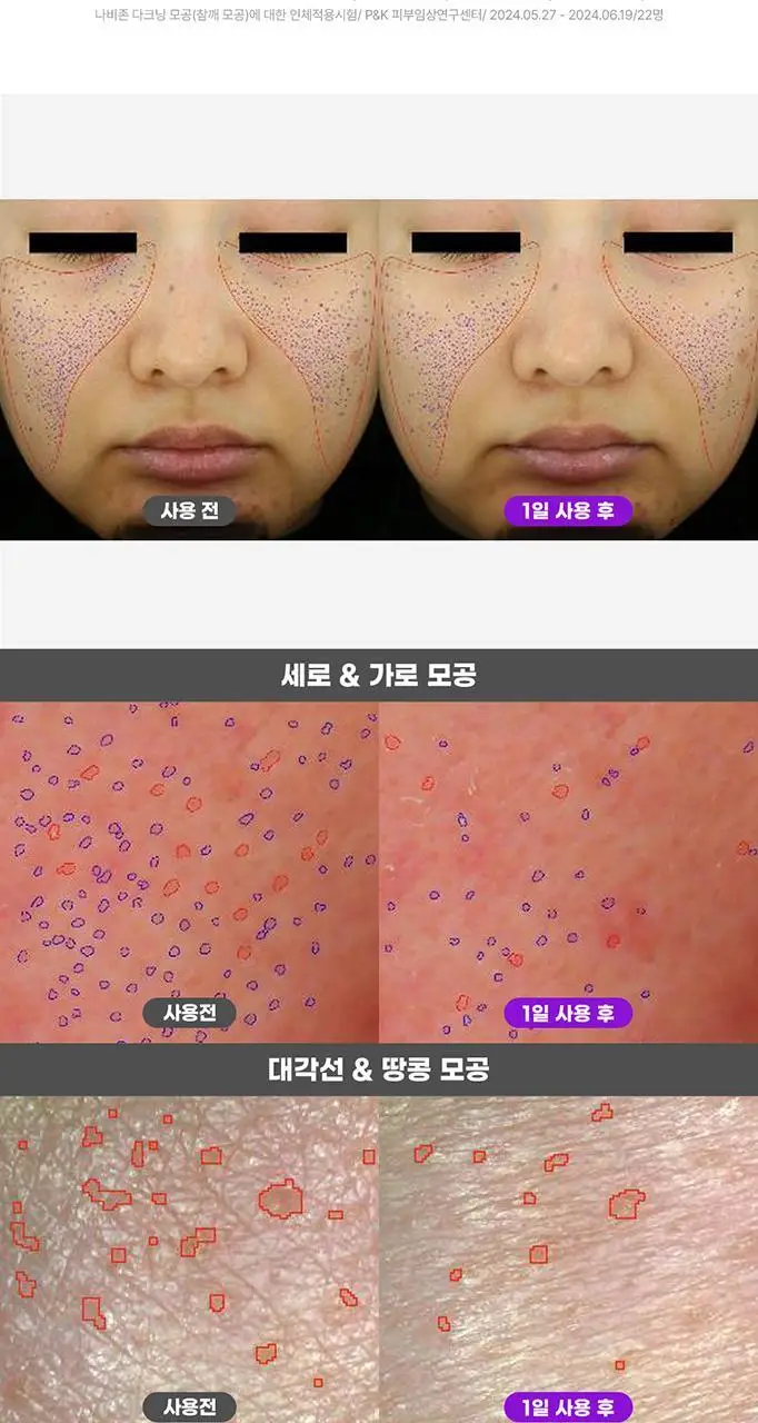 [단독기획/대용량] 파티온 노스카나인 트러블 모공탄력 세럼 50ml 기획(+5ml+크림 5ml) 상세페이지 17